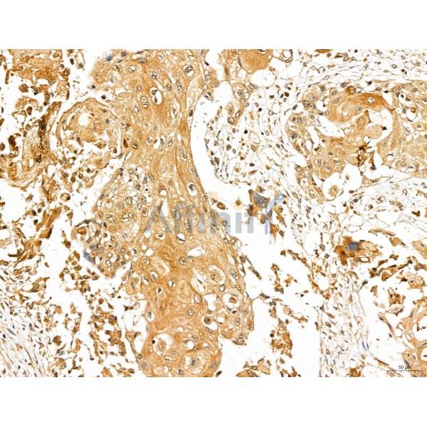LOH12CR1 Antibody - DF13131 at 1/100 staining Human esophageal cancer by IHC-P.