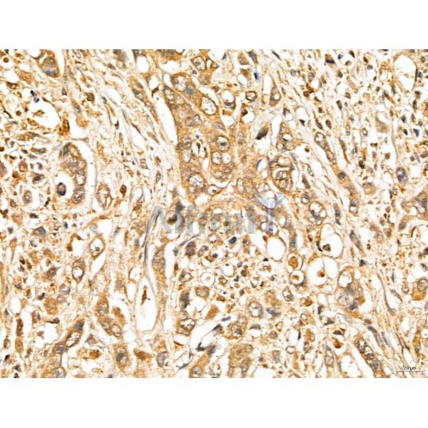 LOH12CR1 Antibody - DF13131 at 1/100 staining Human gastric cancer by IHC-P.
