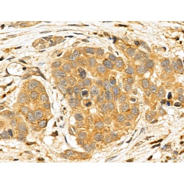 LOH12CR1 Antibody - DF13131 at 1/100 staining Human mammary cancer by IHC-P.