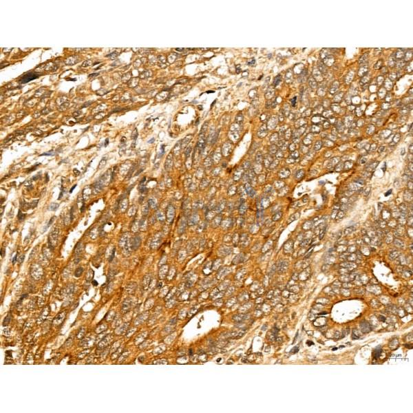 LOH12CR1 Antibody - DF13131 at 1/100 staining Human colorectal cancer by IHC-P.
