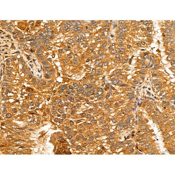 LOH12CR1 Antibody - DF13131 at 1/100 staining Human lung cancer by IHC-P.