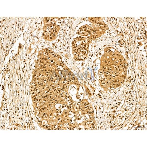 LZTFL1 Antibody - DF13134 at 1/100 staining Human esophageal cancer by IHC-P.