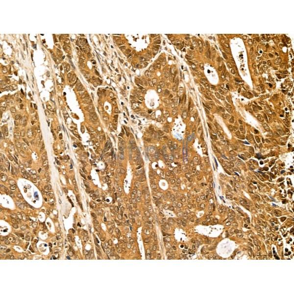 LZTFL1 Antibody - DF13134 at 1/100 staining Human colorectal cancer by IHC-P.