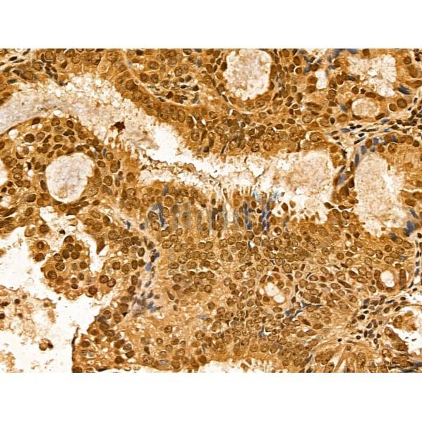 LZTFL1 Antibody - DF13134 at 1/100 staining Human lung cancer by IHC-P.