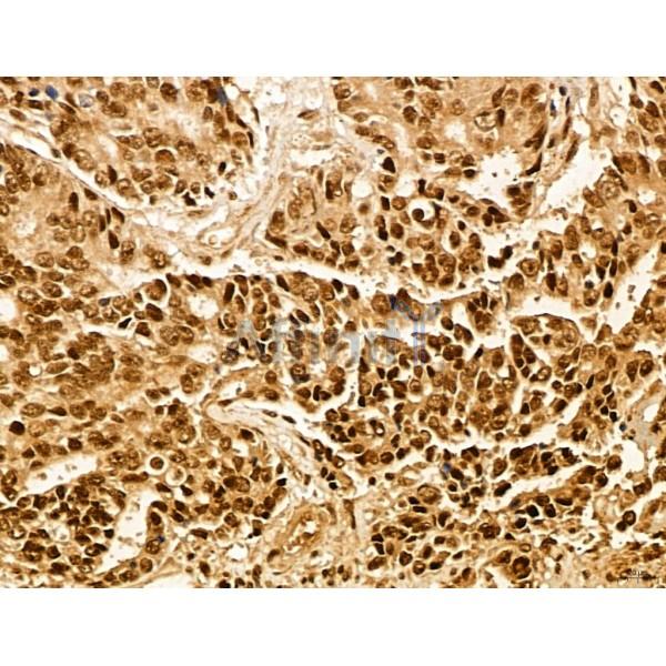 MACC1 Antibody - DF13135 at 1/100 staining Human colorectal cancer by IHC-P.