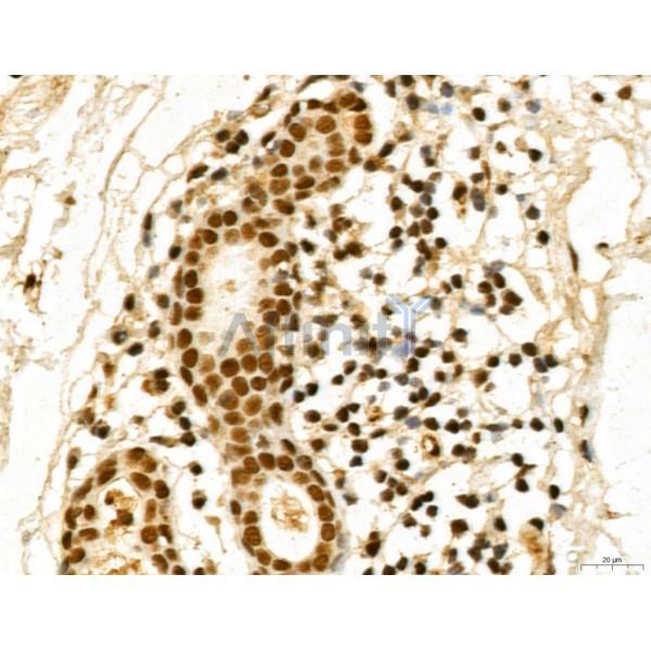 MACC1 Antibody - DF13135 at 1/100 staining Human normal tissues adjacent to esophageal cancer by IHC-P.