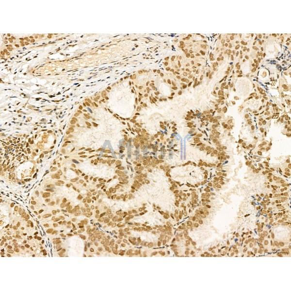 MACC1 Antibody - DF13135 at 1/100 staining Human lung cancer by IHC-P.