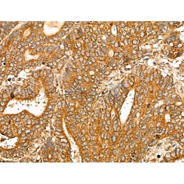 MAN1A2 Antibody - DF13136 at 1/100 staining Human colorectal cancer by IHC-P.