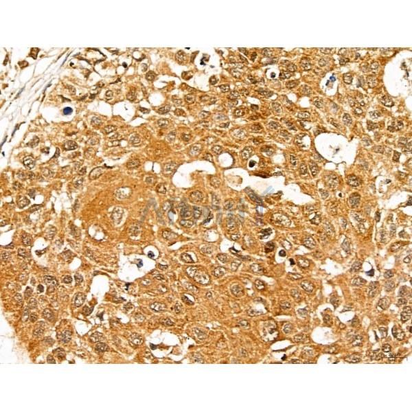 MAN1A2 Antibody - DF13136 at 1/100 staining Human esophageal cancer by IHC-P.