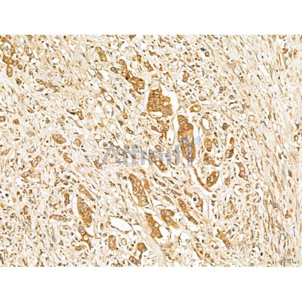 MAN1A2 Antibody - DF13136 at 1/100 staining Human gastric cancer by IHC-P.