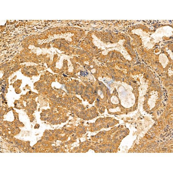 MAN1A2 Antibody - DF13136 at 1/100 staining Human lung cancer by IHC-P.