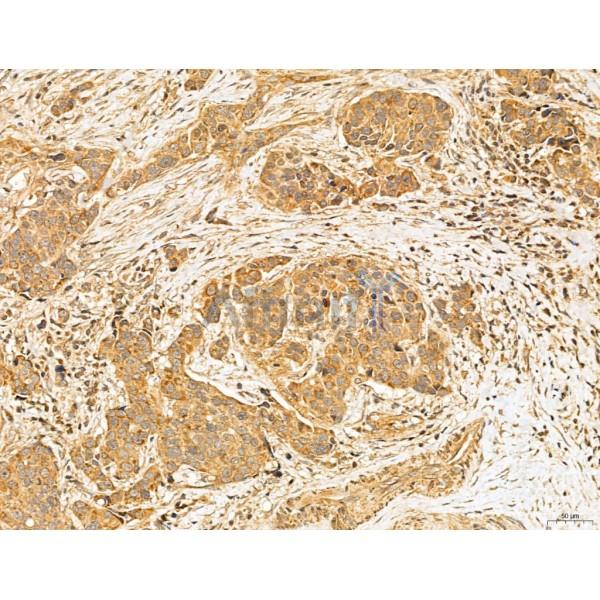 MAN1A2 Antibody - DF13136 at 1/100 staining Human mammary cancer by IHC-P.