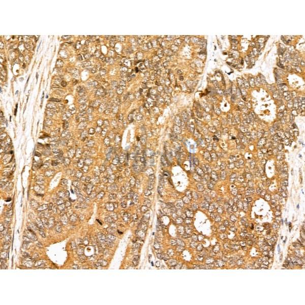 MAP1S Antibody - DF13137 at 1/100 staining Human colorectal cancer by IHC-P.