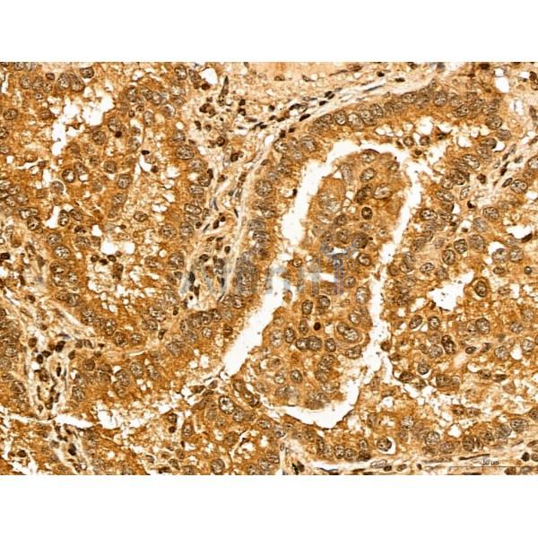 MAP1S Antibody - DF13137 at 1/100 staining Human lung cancer by IHC-P.