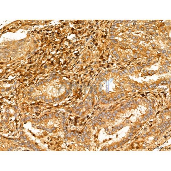 MAT2A Antibody - DF13139 at 1/100 staining Human lung cancer by IHC-P.
