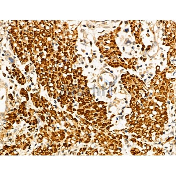 MAT2A Antibody - DF13139 at 1/100 staining Human gastric cancer by IHC-P.