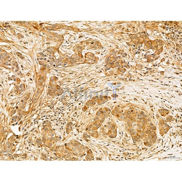 MAT2A Antibody - DF13139 at 1/100 staining Human mammary cancer by IHC-P.