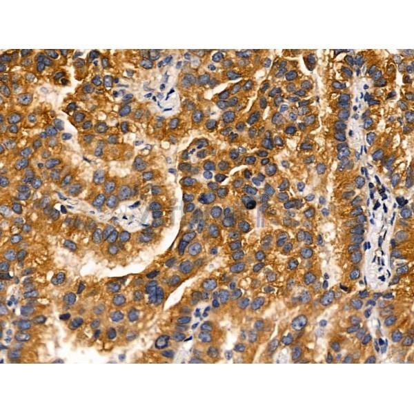 MLK2 Antibody - DF13152 at 1/100 staining Human lung cancer by IHC-P.