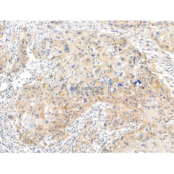 KGF Antibody - DF13342 at 1/100 staining Human esophageal cancer by IHC-P.
