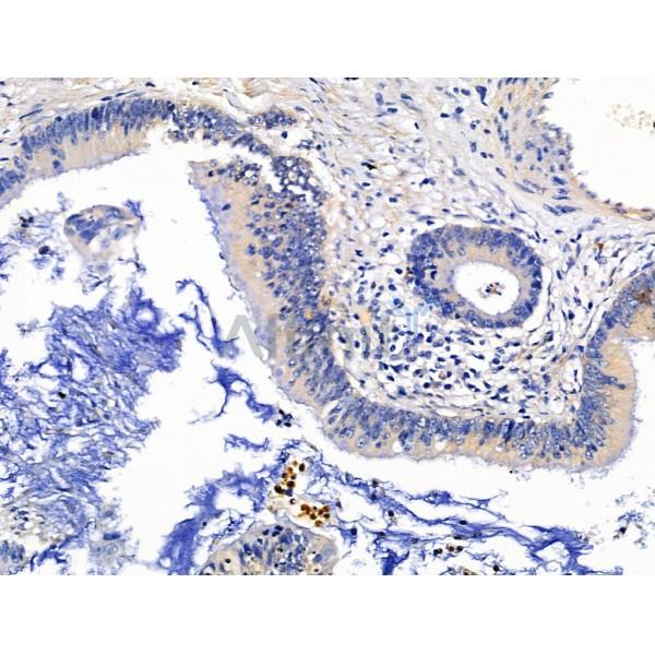 KGF Antibody - DF13342 at 1/100 staining Human colorectal cancer by IHC-P.