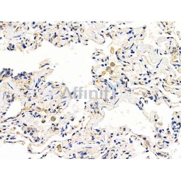 PICALM Antibody - DF13343 at 1/100 staining Human lung cancer and adjacent normal tissues by IHC-P.