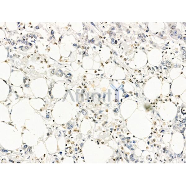 MUM1 Antibody - DF13418 at 1/100 staining Human gastric cancer by IHC-P.