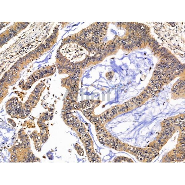 LYRIC Antibody - DF13437 at 1/100 staining Human colorectal cancer by IHC-P.