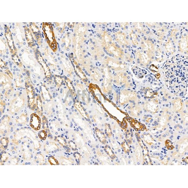 ECM2 Antibody - DF13455 at 1/100 staining Human kidney cancer and adjacent normal tissues by IHC-P.