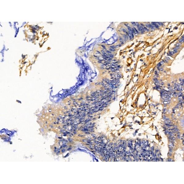 T Plastin Antibody - DF13459 at 1/100 staining Human colorectal cancer by IHC-P.
