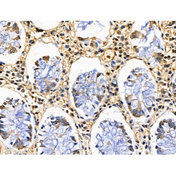 CBX4 Antibody - DF13461 at 1/100 staining Human gastric cancer and adjacent normal tissues by IHC-P.