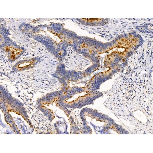 BIRC6 Antibody - DF13472 at 1/100 staining Human colorectal cancer by IHC-P.