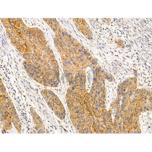 BIRC6 Antibody - DF13472 at 1/100 staining Human esophageal cancer by IHC-P.