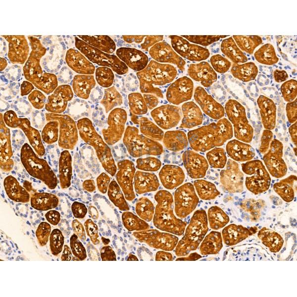 IEX1 Antibody - DF13488 at 1/100 staining Human kidney cancer and adjacent normal tissues by IHC-P.