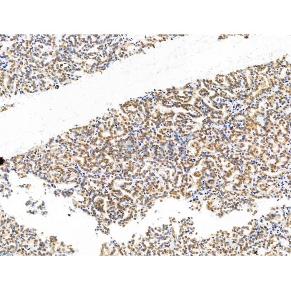 CASC5 Antibody - DF13491 at 1/100 staining Human kidney cancer by IHC-P.