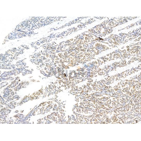 CASC5 Antibody - DF13491 at 1/100 staining Human kidney cancer by IHC-P.