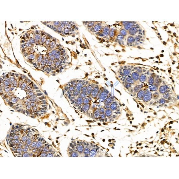 SLFN11 Antibody - DF13515 at 1/100 staining Human colorectal cancer and adjacent normal tissues by IHC-P.