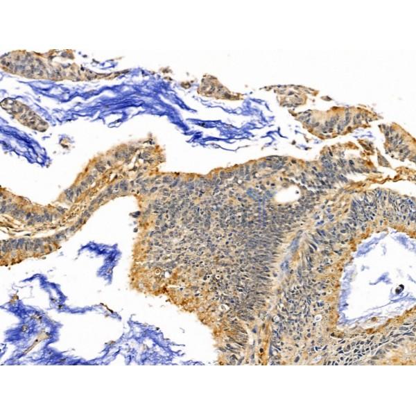 SLFN11 Antibody - DF13515 at 1/100 staining Human colorectal cancer by IHC-P.