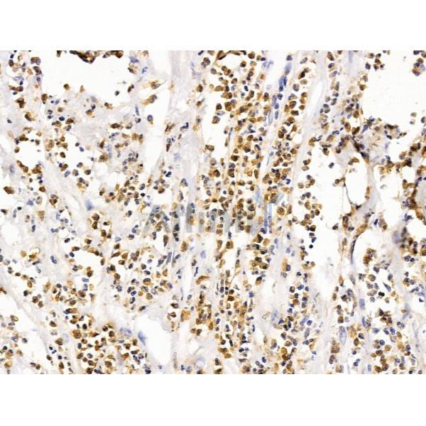 LMX1A Antibody - DF13518 at 1/100 staining Human pancreatic cancer by IHC-P.