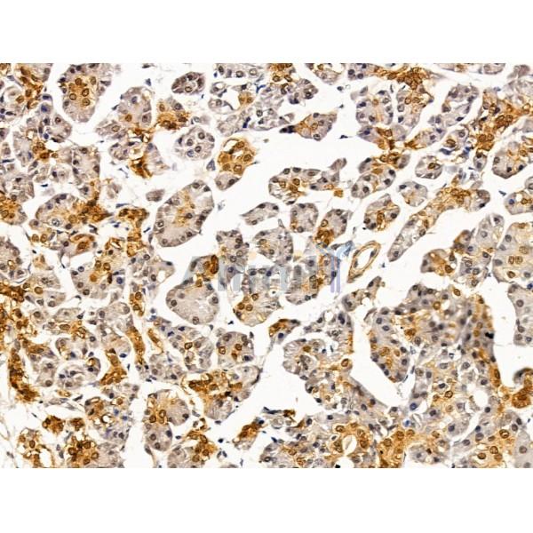 LMX1A Antibody - DF13518 at 1/100 staining Human pancreatic cancer and adjacent nomal tissues by IHC-P.