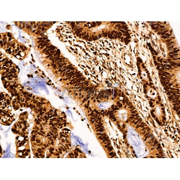 SET Antibody - DF13529 at 1/100 staining Human colorectal cancer by IHC-P.