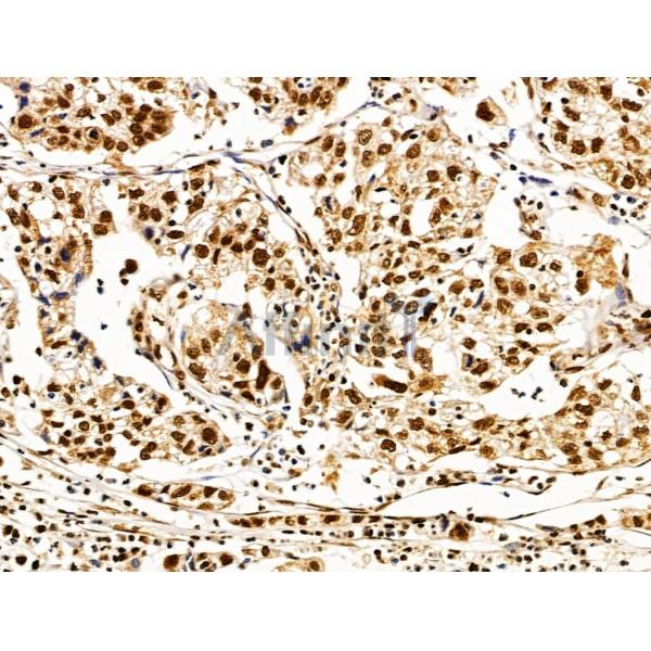 SET Antibody - DF13529 at 1/100 staining Human pancreatic cancer by IHC-P.