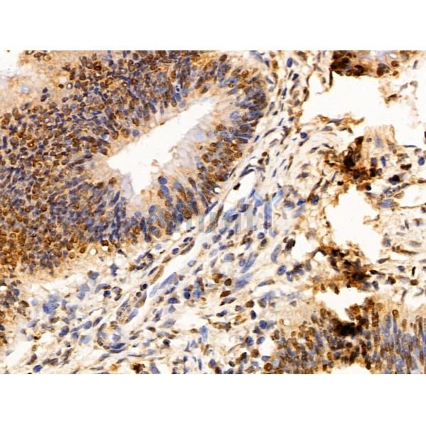 SET Antibody - DF13529 at 1/100 staining Human colorectal cancer by IHC-P.