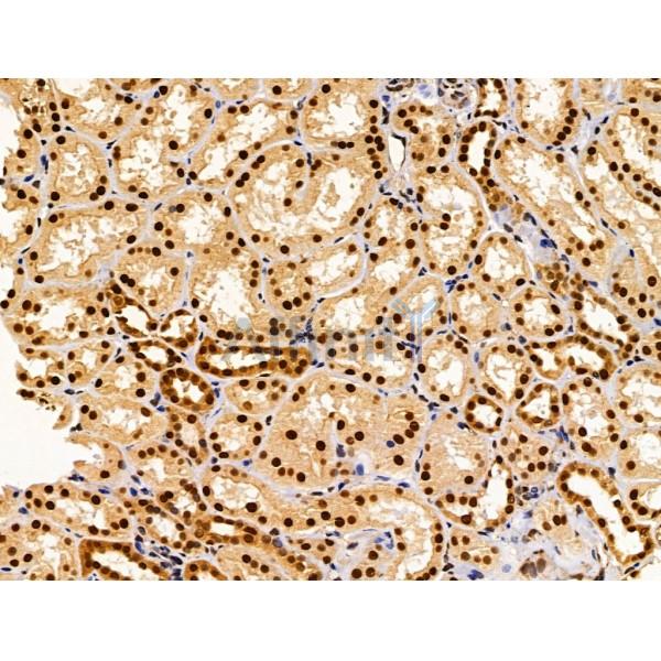 SET Antibody - DF13529 at 1/100 staining Human kidney cancer and adjacent normal tissues by IHC-P.