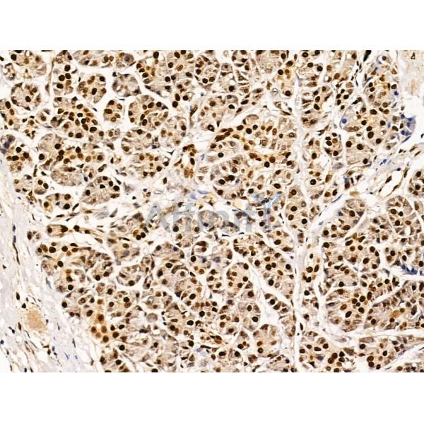 Proprotein Convertase 2 Antibody - DF13531 at 1/100 staining Human pancreatic cancer and adjacent nomal tissues by IHC-P.