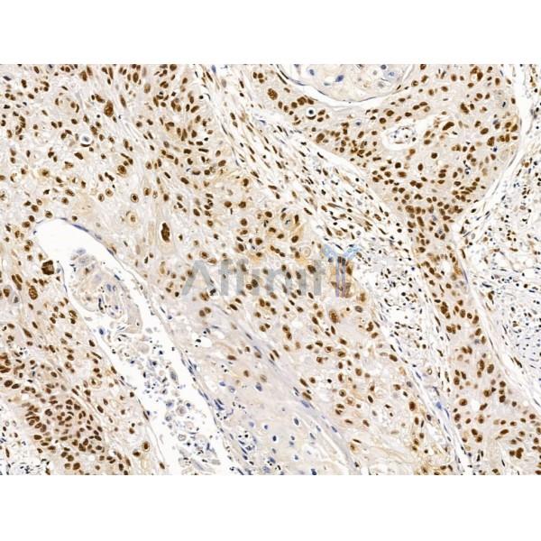Proprotein Convertase 2 Antibody - DF13531 at 1/100 staining Human colorectal cancer and adjacent normal tissues by IHC-P.