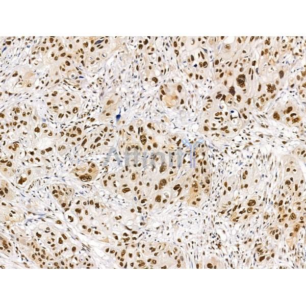 Proprotein Convertase 2 Antibody - DF13531 at 1/100 staining Human esophageal cancer by IHC-P.