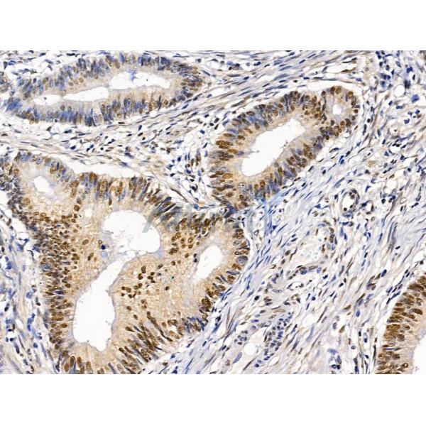 Proprotein Convertase 2 Antibody - DF13531 at 1/100 staining Human colorectal cancer by IHC-P.