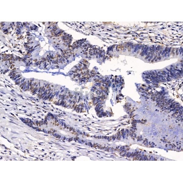 PHAP1 Antibody - DF13532 at 1/100 staining Human colorectal cancer by IHC-P.
