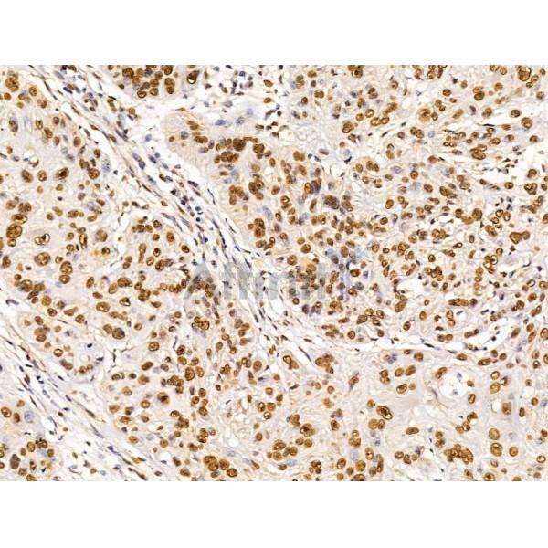 PHAP1 Antibody - DF13532 at 1/100 staining Human esophageal cancer by IHC-P.