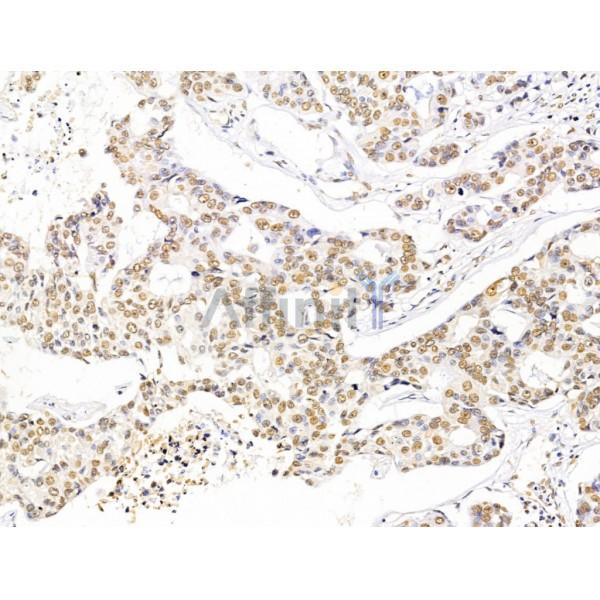 PHAP1 Antibody - DF13532 at 1/100 staining Human mammary cancer by IHC-P.